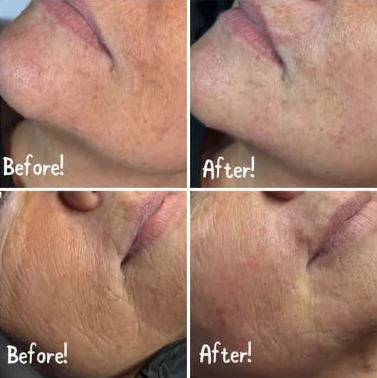 Before and after nasolabial fold treatment