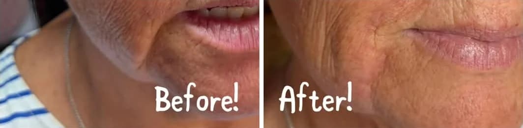 Before and after Sosum soft skin booster treatment